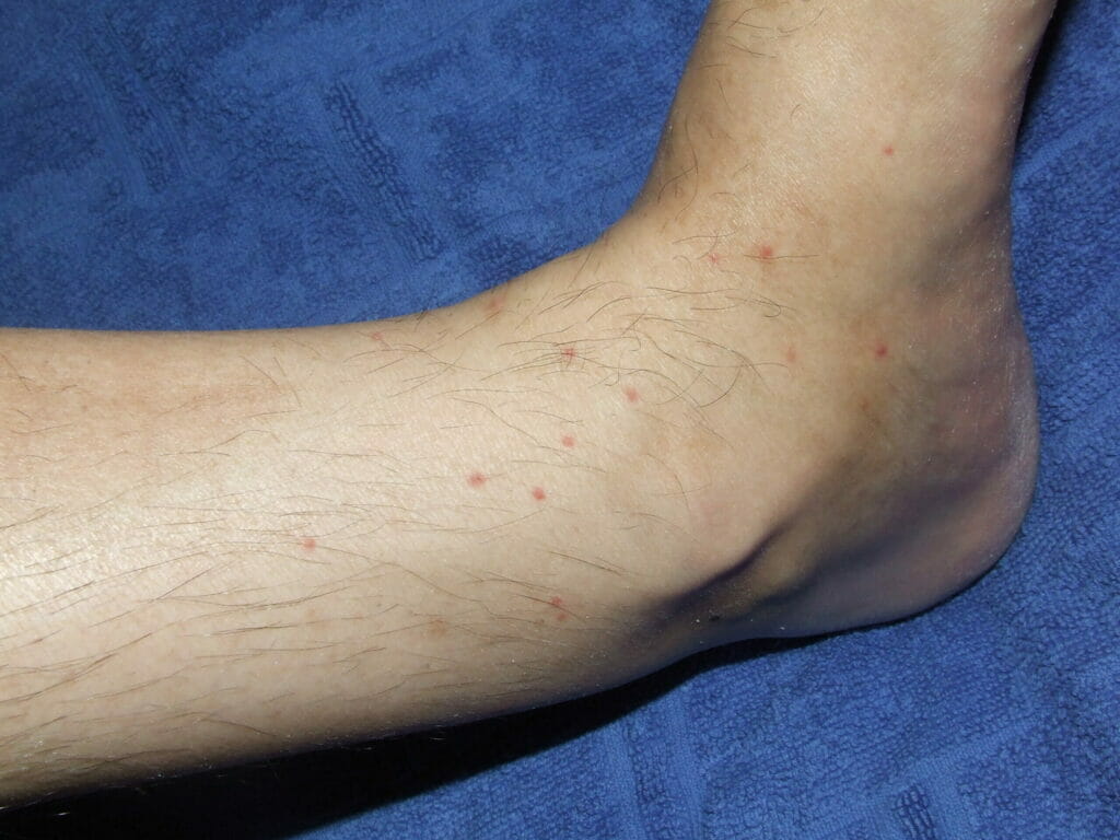 bed bug bites on leg