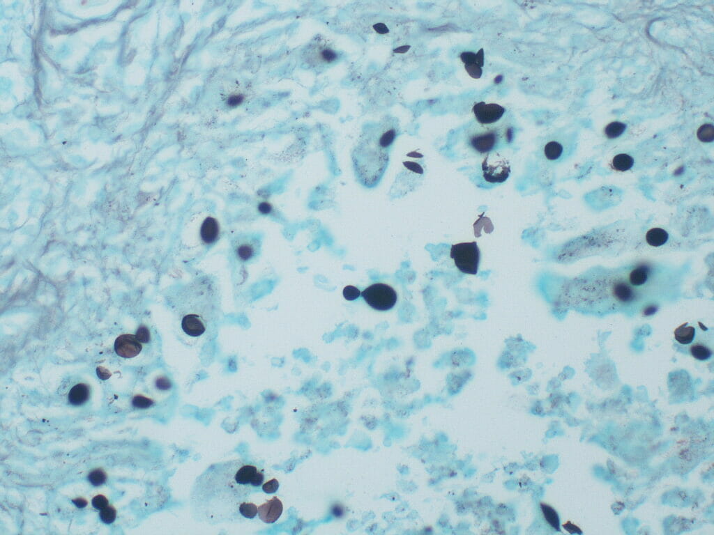 Cryptococcosis from pigeons