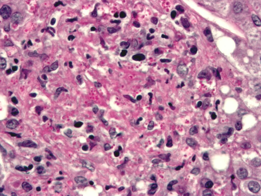 Histoplasmosis from pigeons